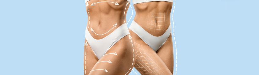 Liposuktion OP Methoden zwei Frauenkörper