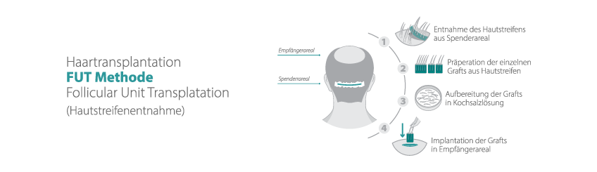 So funktioniert die FUT Haartransplantation Methode